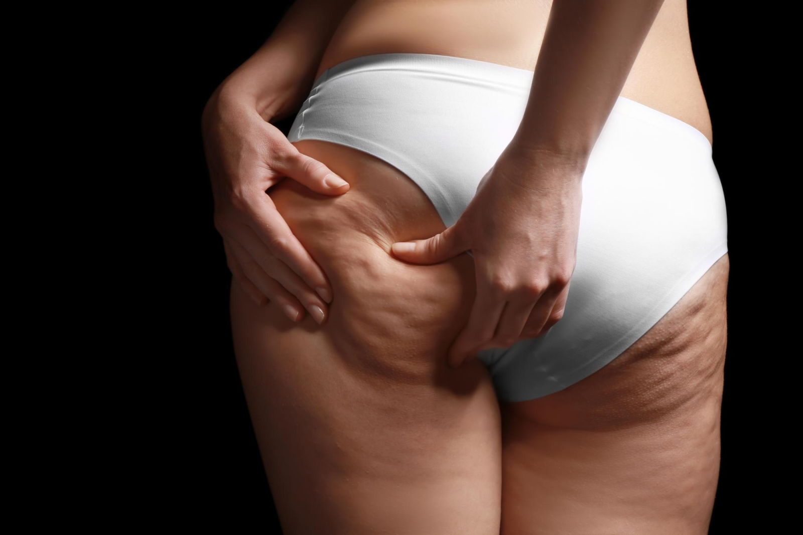 Cellulite