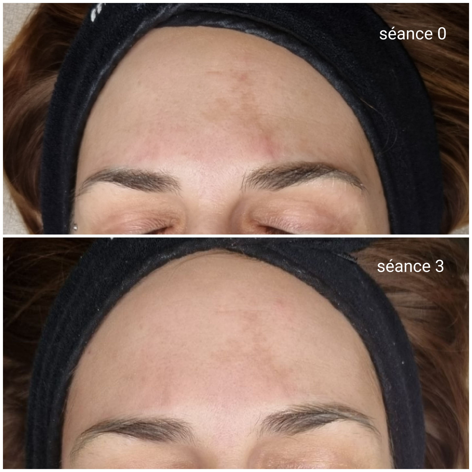 Peeling Melanostop - tâche pigmentaire