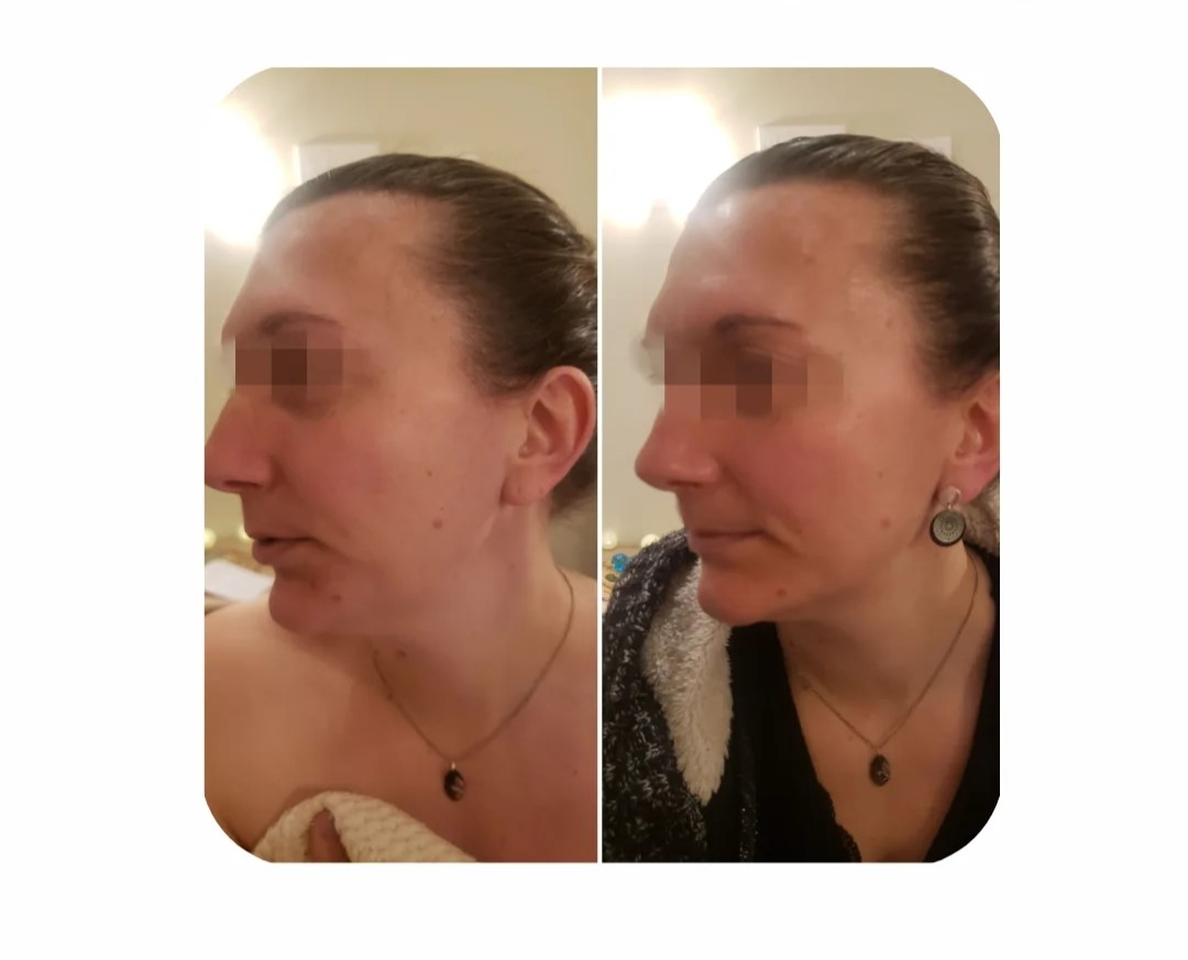 Stretching facial - ovale du visage