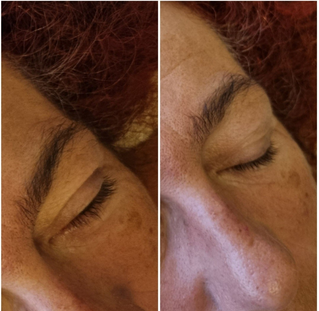 Stretching facial - Lift paupières