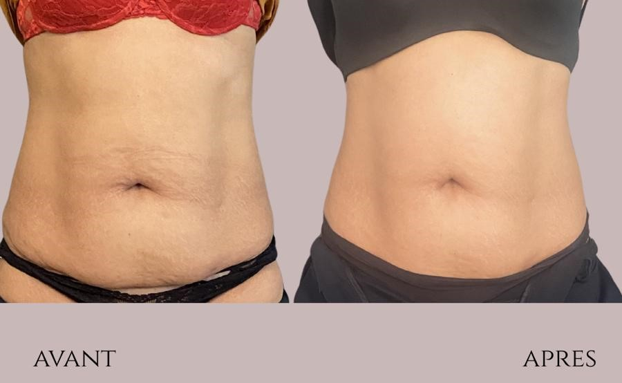 Belly Sculpt