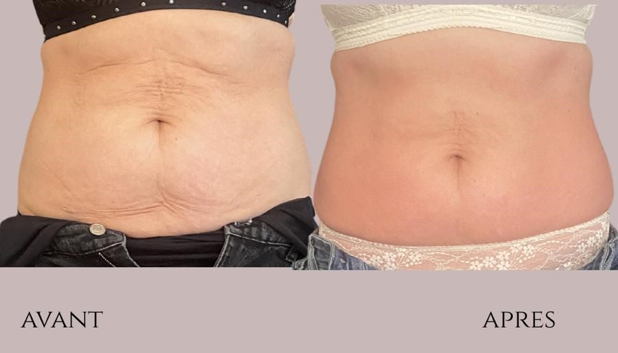 Belly Sculpt