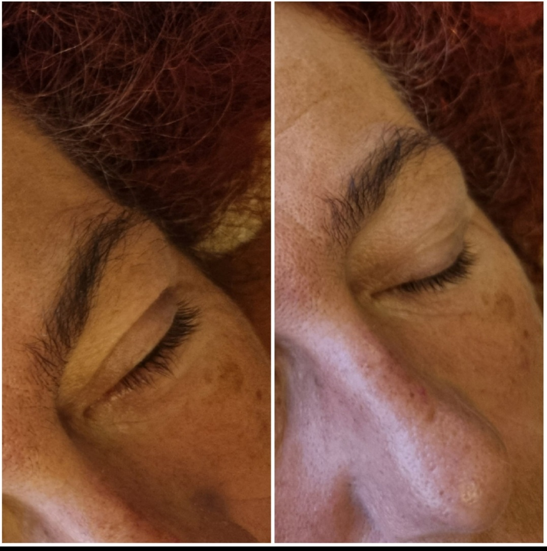 Stretching facial - Lift paupières