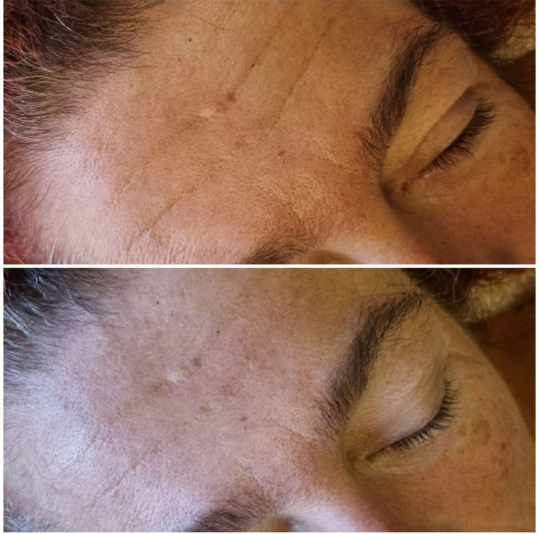 Stretching facial - Rides du front