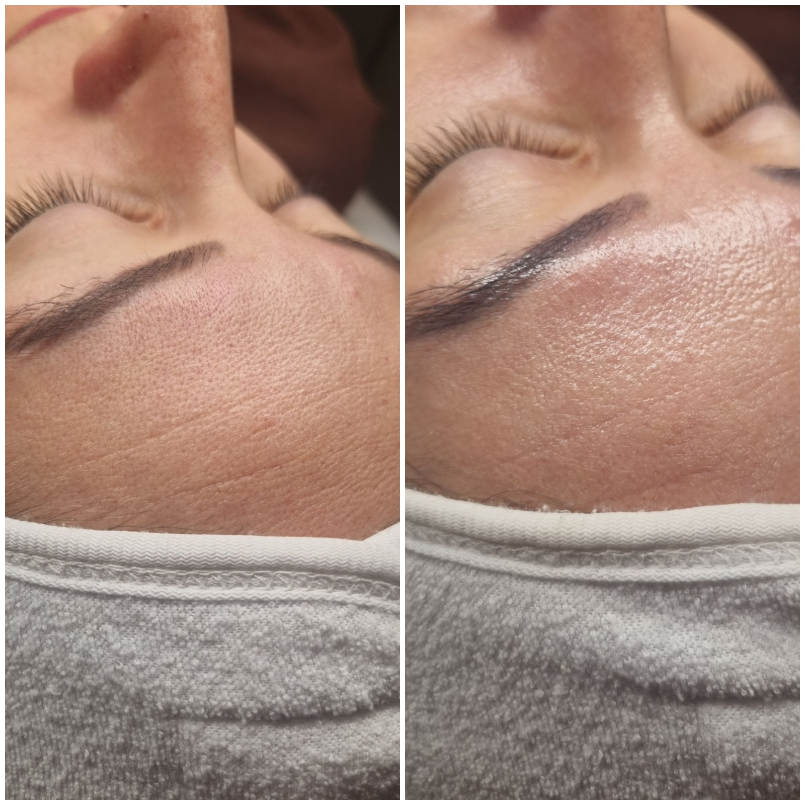 Hydraface